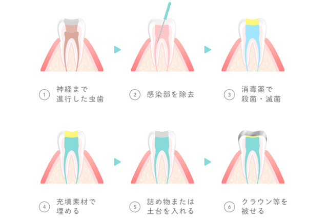 根管治療の流れ