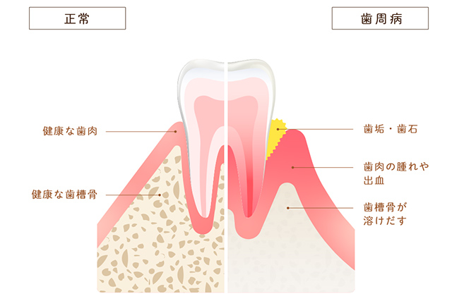 健康な歯と歯周病の歯