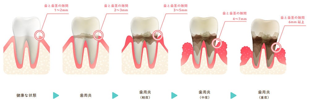 歯周病の進行段階