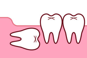 親知らずが完全に埋まっている状態のイラスト