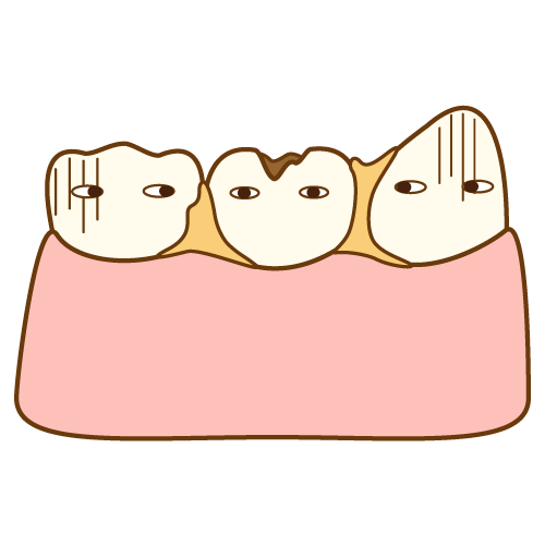 歯と歯の間にものが挟まるのはなんで？