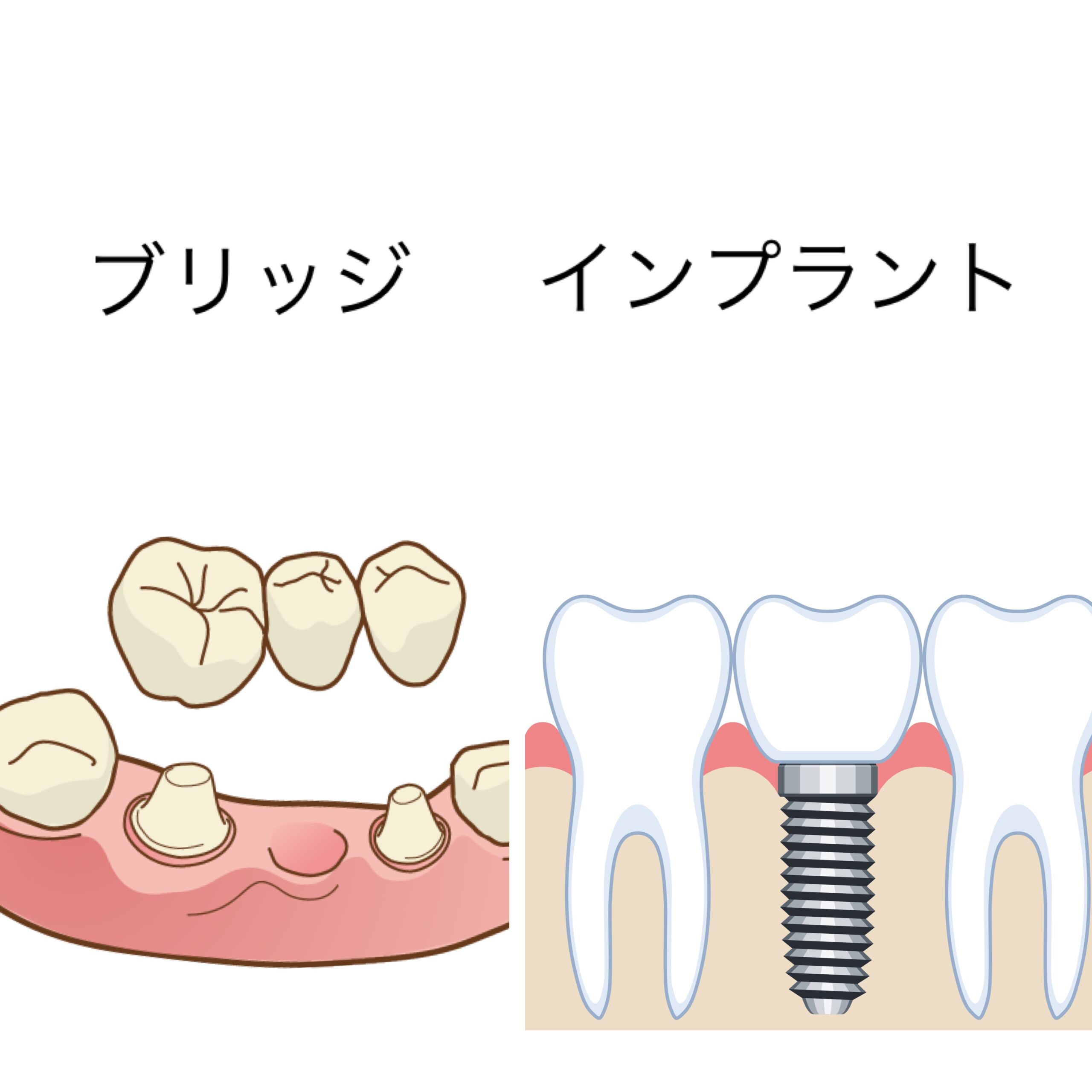 インプラントとブリッジどっちがいいの?費用・期間・耐久性徹底比較