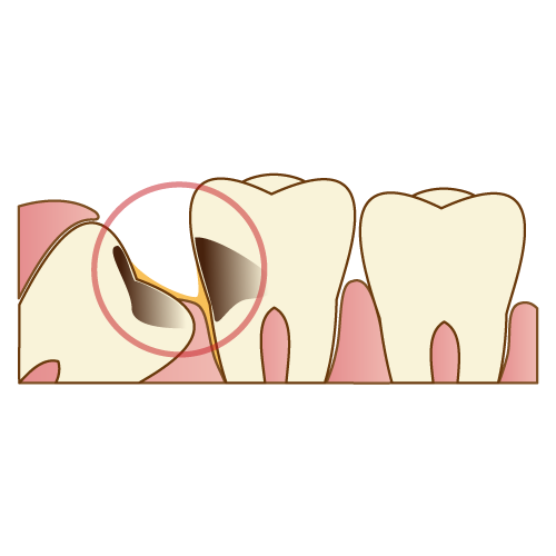 横向きの親知らずを放置するとどうなる？渋谷の歯医者が解説