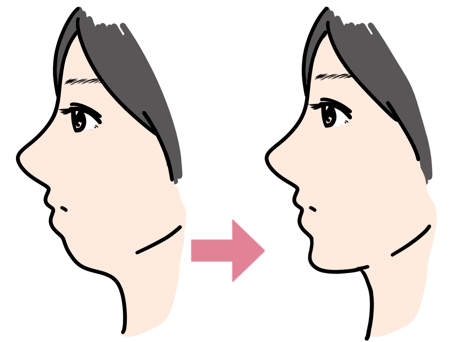 口ゴボの矯正は抜歯必須？