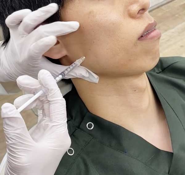 歯科ボトックス治療