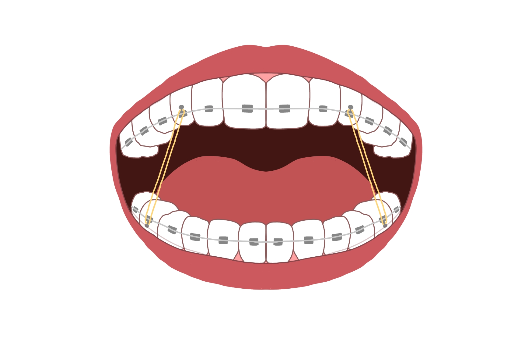 矯正治療の必需品。顎間ゴムって?渋谷の歯科医が解説!