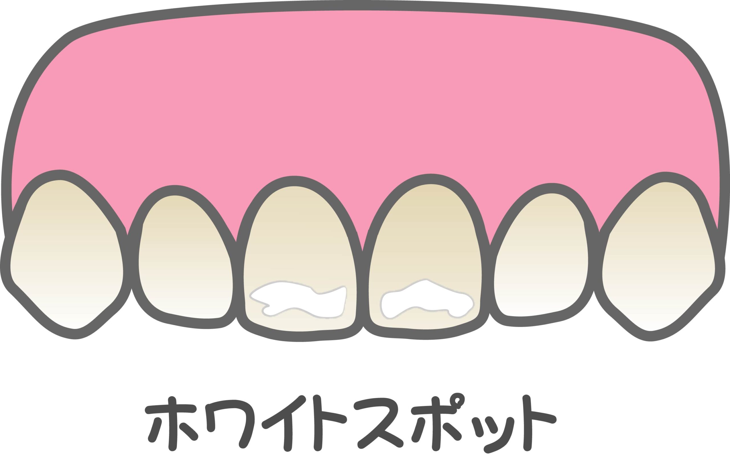 ホワイトスポットって?原因と治療法を渋谷の歯医者が解説