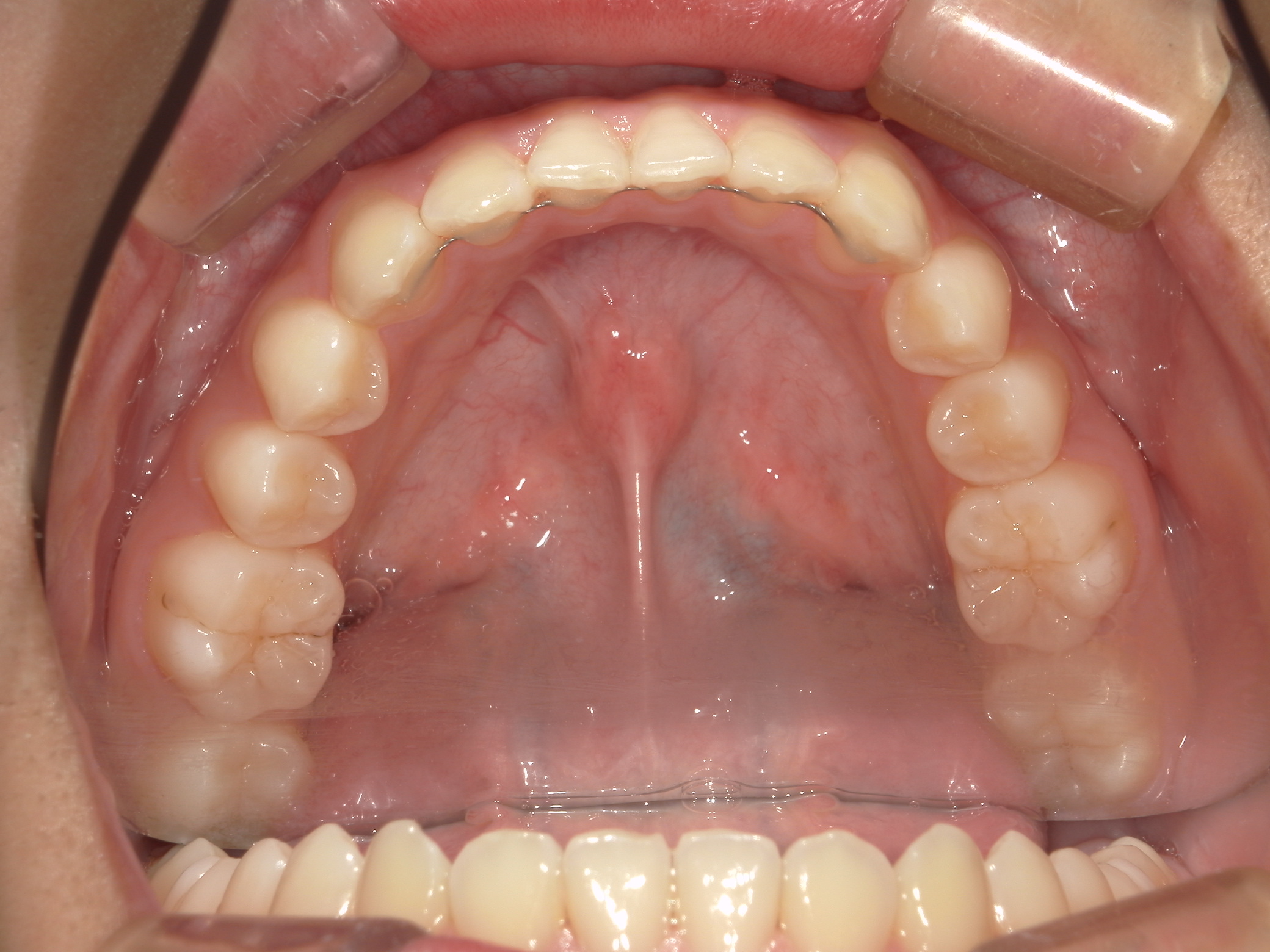 矯正後の保定ってどれくらいしたらいいの?どんな種類があるの?