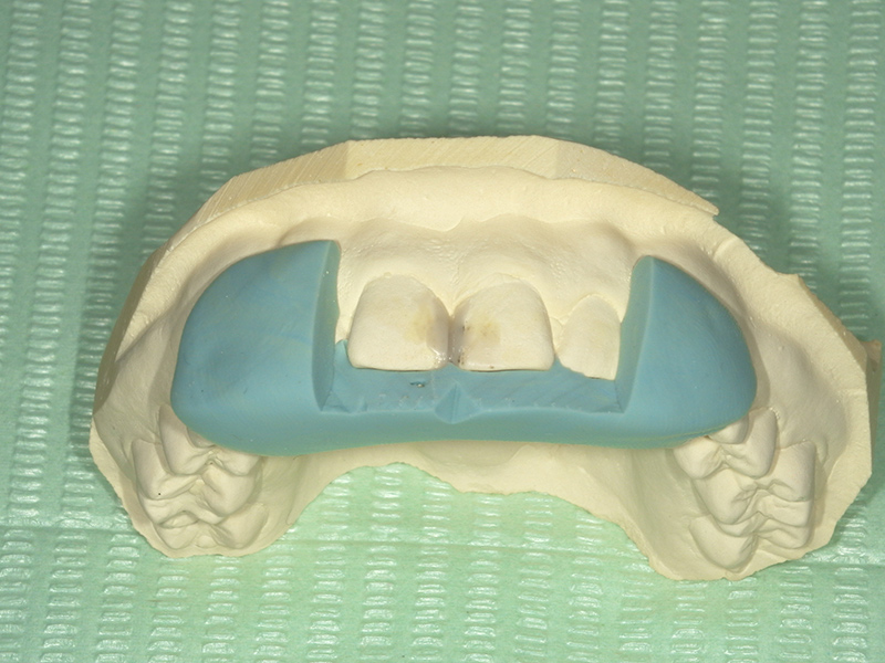 ワックスアップ・コアの作成