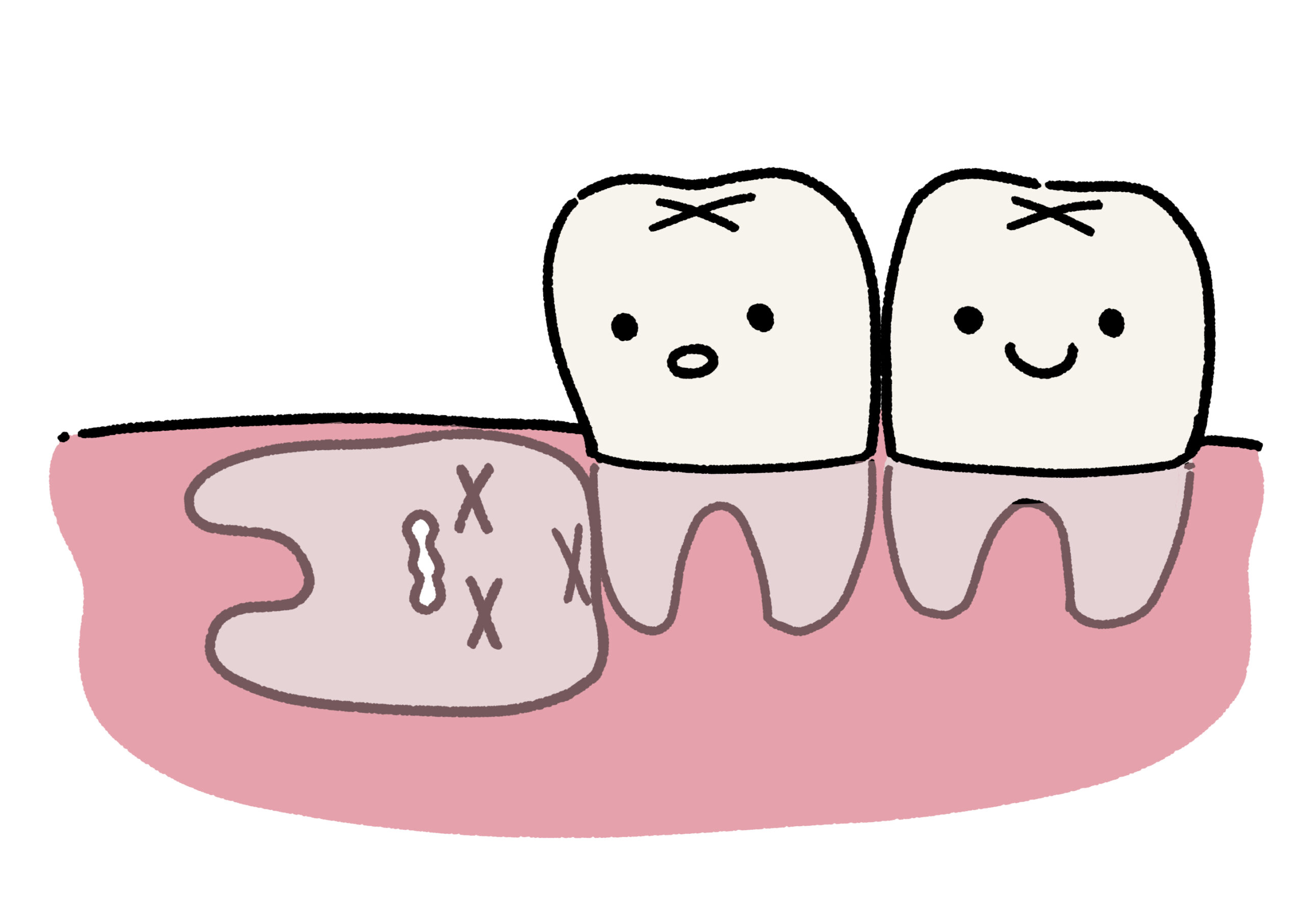 親知らずを抜くと小顔になるって本当？渋谷の歯医者が真実を解説